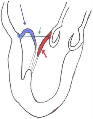 Microinvasive mitral valve repair with transapical mitral neochordae implantation